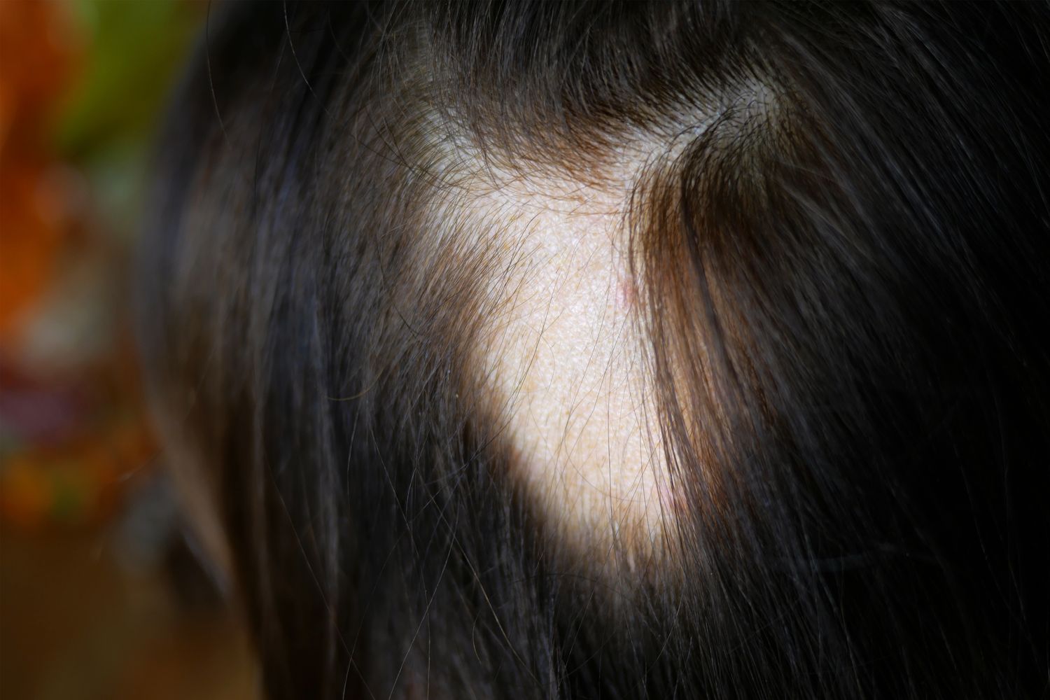 Close-up of a small bare patch on a scalp